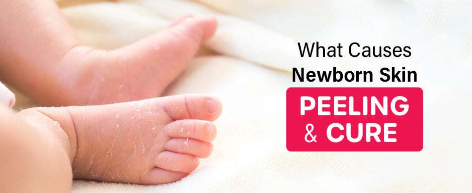 What Causes Newborn Skin Peeling and Cure