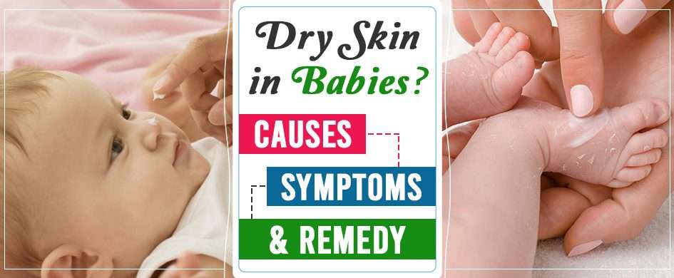Dry Skin In Babies: Causes, Symptoms And Remedy