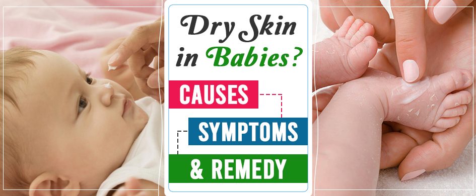 Dry Skin In Babies: Causes, Symptoms And Remedy
