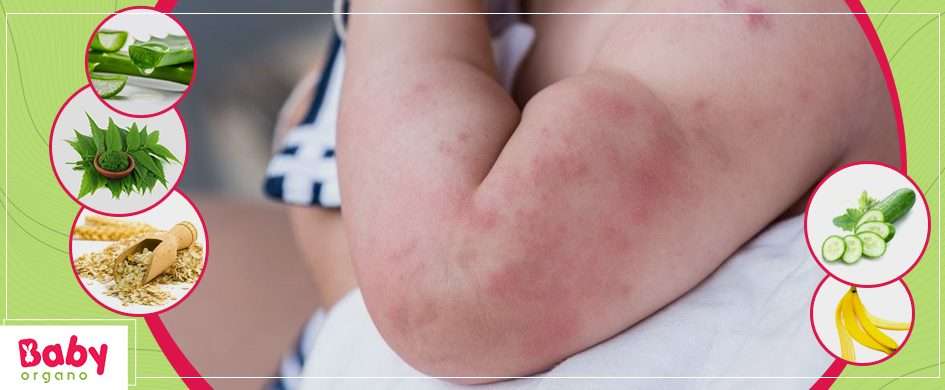 Tip & Remedies to treat Rashes